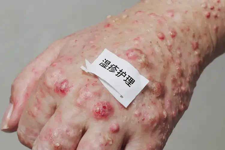 大学生手上偶尔起湿疹能够彻底治愈吗(图4)