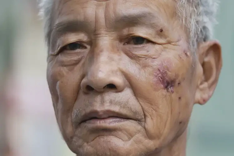 高齡老人面部容易起濕疹不管它會自己痊愈嗎(圖3)