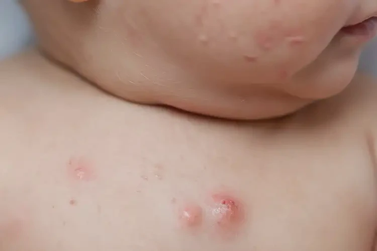 寶寶脖子起濕疹能治好嗎(圖4)