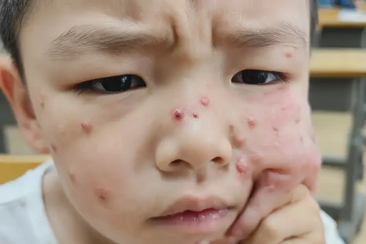 小學(xué)生身上容易長濕疹可以治好嗎(圖4)