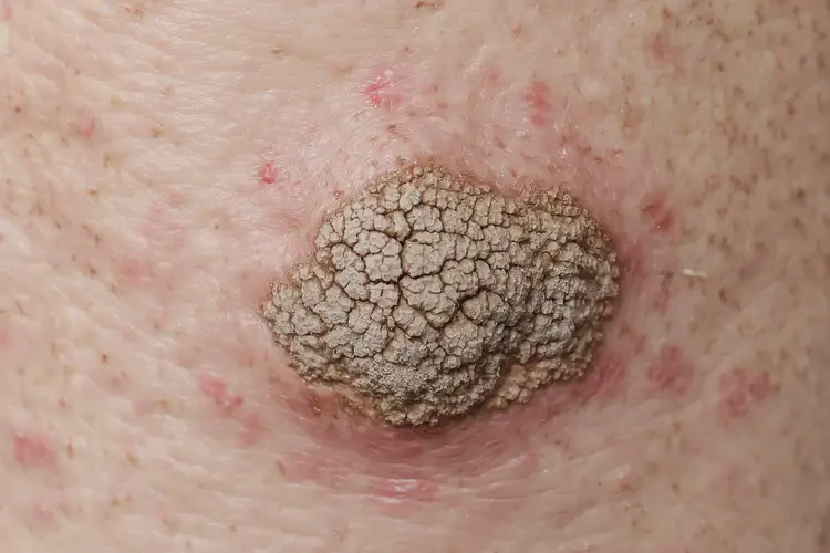 男性身上容易长湿疹不管它会自己自愈吗(图3)