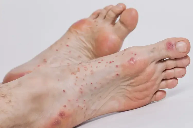 男生腳上出濕疹可以治好嗎(圖4)