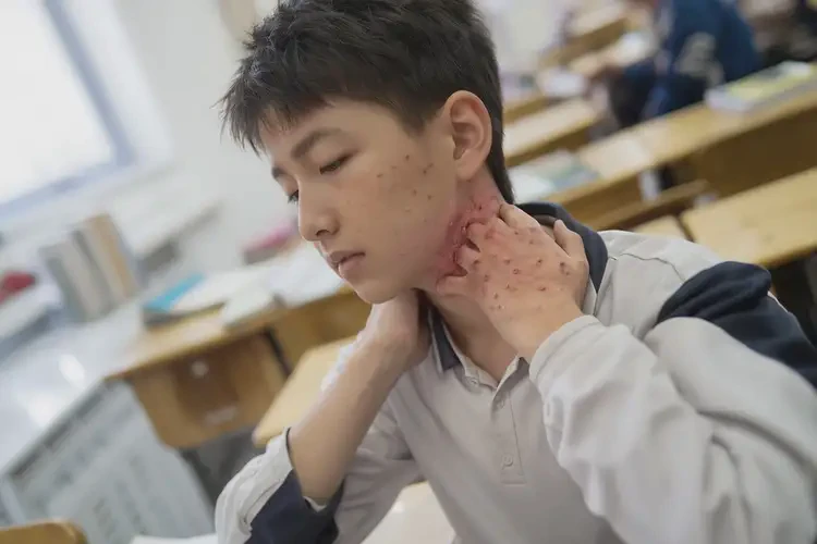 中學(xué)生脖子上偶爾長濕疹可不可以徹底自愈(圖4)