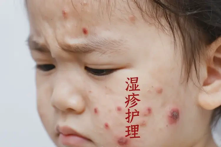 小兒臉上出濕疹可以治好嗎(圖4)