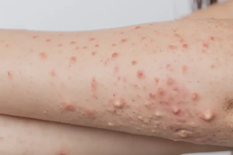 女性手臂上有濕疹可以治好嗎(圖4)