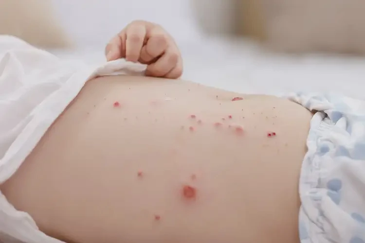 寶寶肚子上偶爾長濕疹能治好嗎(圖4)