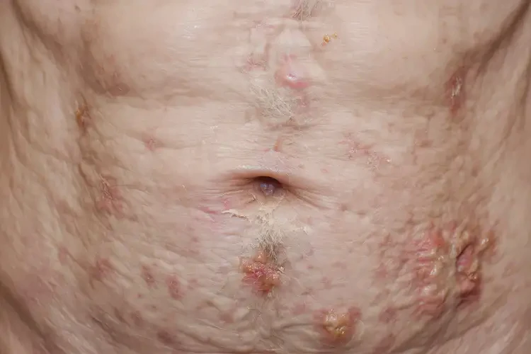 高龄老人肚子长湿疹能彻底自愈吗(图4)