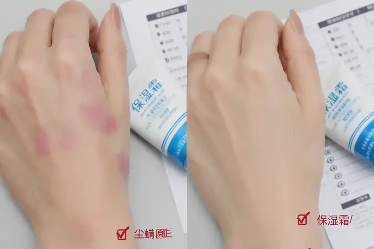 女性手上容易起濕疹可以治好嗎(圖4)