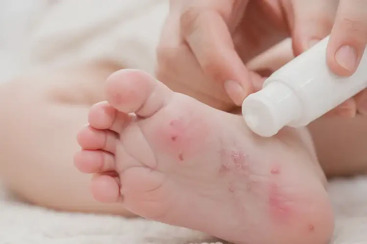 寶寶腳上有濕疹可以治好嗎(圖3)