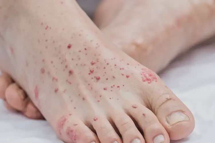 產婦腳上出現(xiàn)濕疹可以治好嗎(圖4)