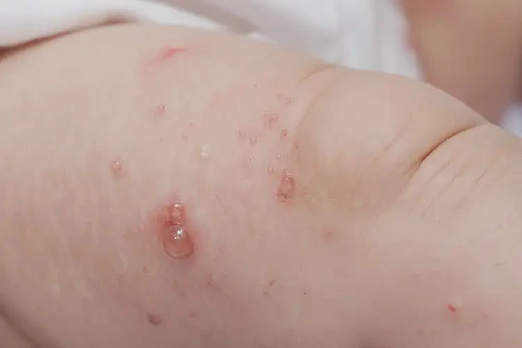 嬰兒小腿上長(zhǎng)濕疹可以治好嗎(圖3)