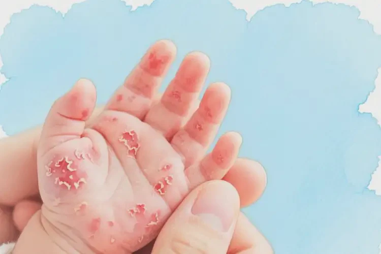 嬰兒四肢長濕疹能治好嗎(圖4)