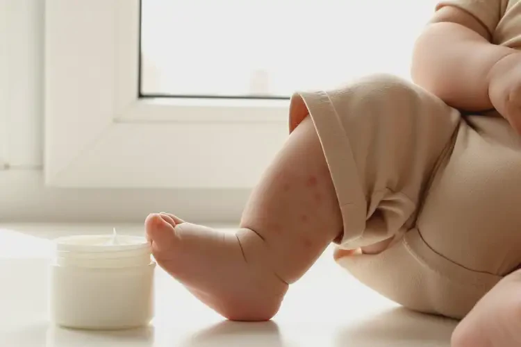 新生儿小腿长湿疹可以治好吗(图4)