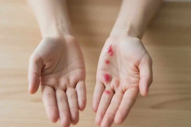 女人手上起濕疹可不可以根治(圖1)