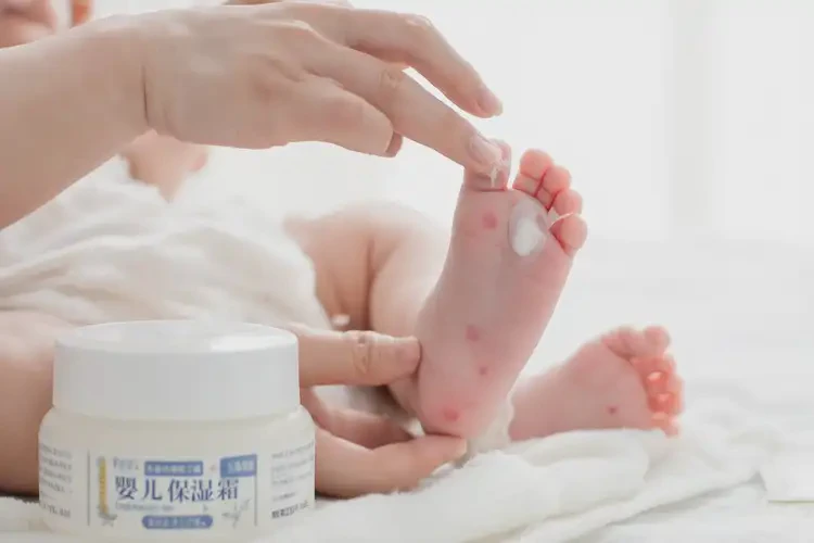 嬰兒腳上出現(xiàn)濕疹能治好嗎(圖3)
