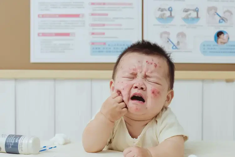 宝宝脸上经常长湿疹可以彻底自愈吗(图4)