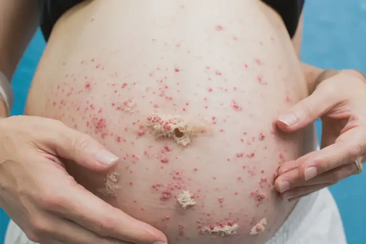 产妇肚子容易长湿疹可以治好吗(图4)