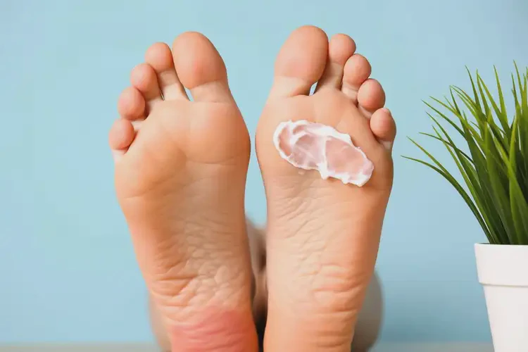 女性腳上容易起濕疹可以治好嗎(圖4)