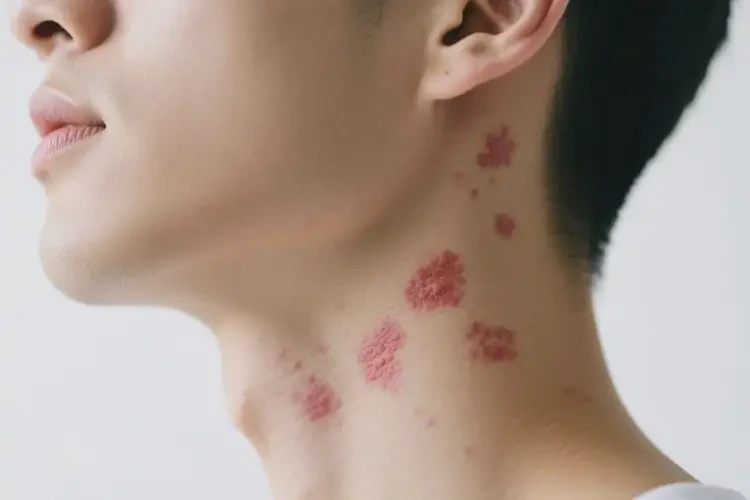 男性脖子经常长湿疹可以治好吗(图4)