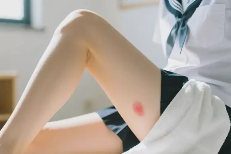 大學(xué)生屁股偶爾起濕疹可以治好嗎(圖3)