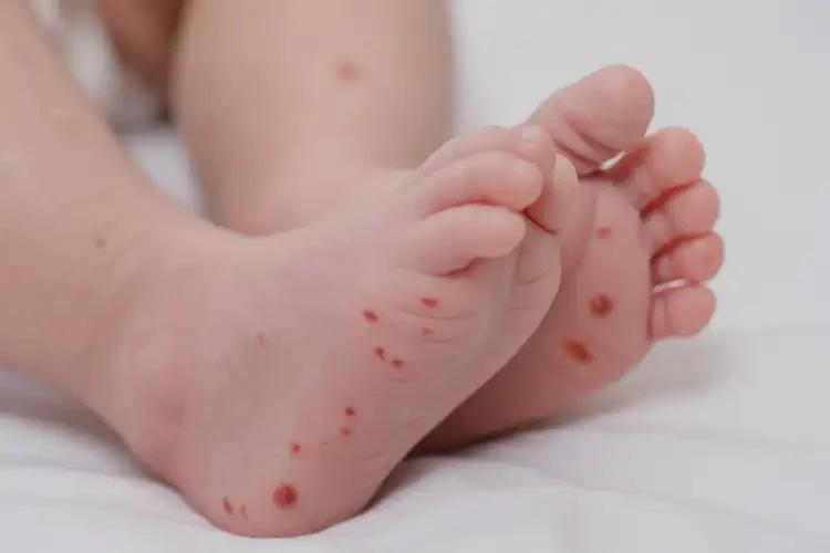 新生儿脚上偶尔长湿疹不管它会自己痊愈吗(图4)