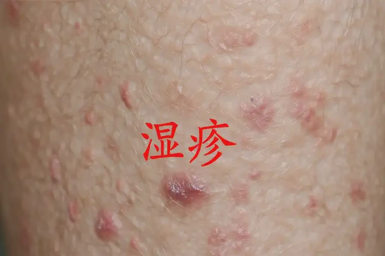 男人小腿經(jīng)常長濕疹可不可以根治(圖2)