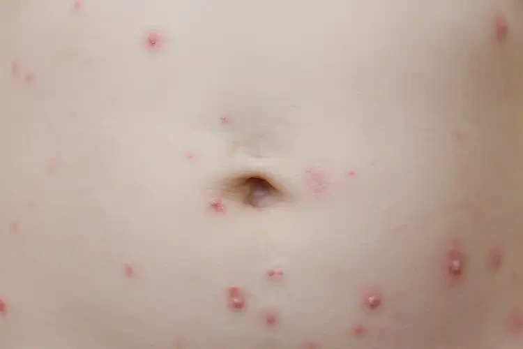 寶寶肚子偶爾長(zhǎng)濕疹可以治好嗎(圖4)