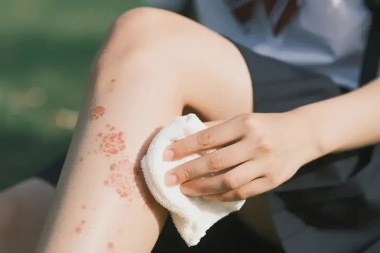 大学生大腿上经常长湿疹可以治好吗(图3)