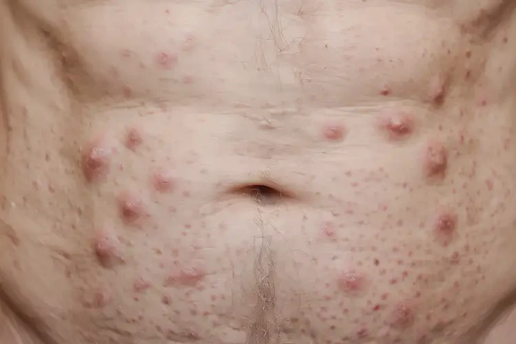 老年人肚子上偶爾起濕疹可以治好嗎(圖1)