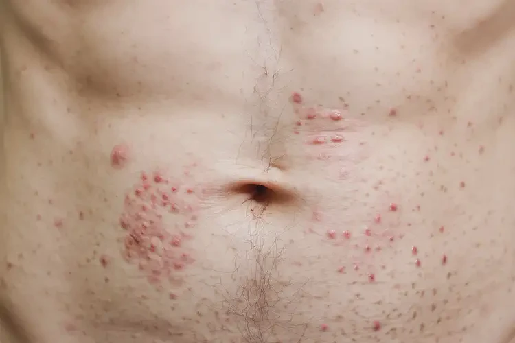 男性肚子上有濕疹可以治好嗎(圖4)