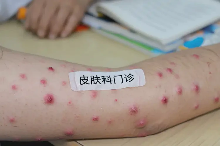 中學(xué)生手臂上有濕疹可以治好嗎(圖4)