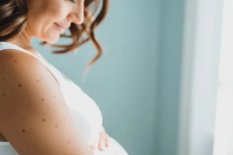 孕婦全身容易長(zhǎng)濕疹可以治好嗎(圖3)