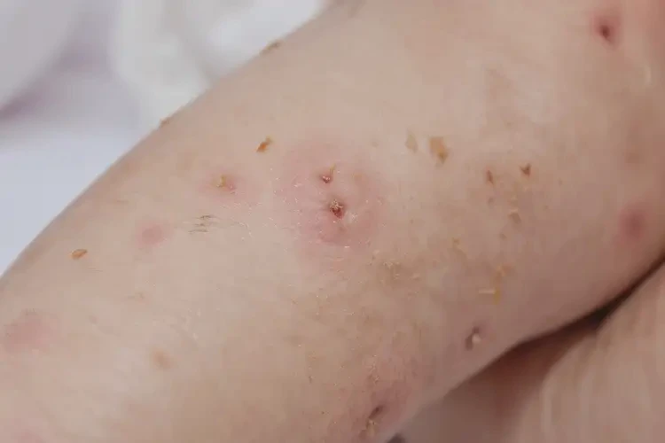 嬰兒大腿上經(jīng)常長濕疹可以治好嗎(圖4)