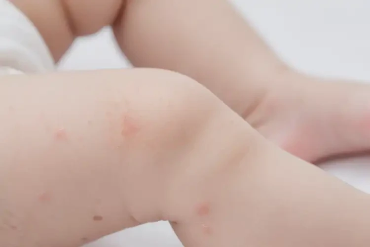 嬰幼兒小腿出現(xiàn)濕疹可以治好嗎(圖4)