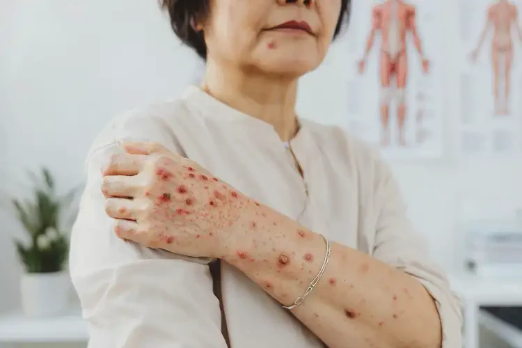 女人四肢經(jīng)常長濕疹可以治好嗎(圖4)