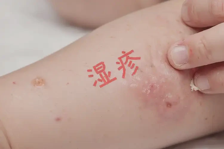 幼兒身上容易長(zhǎng)濕疹可以治好嗎(圖4)