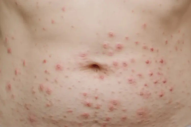 女人肚子上經(jīng)常起濕疹可不可以根治(圖4)