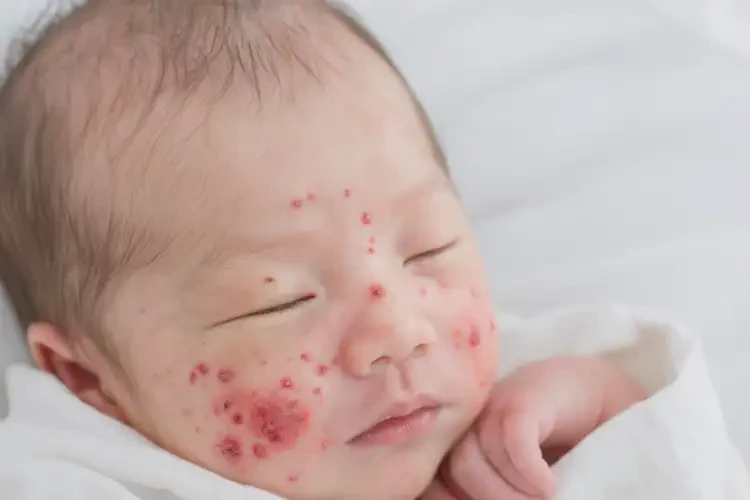 新生兒臉上容易長(zhǎng)濕疹不管它會(huì)自己好嗎(圖4)