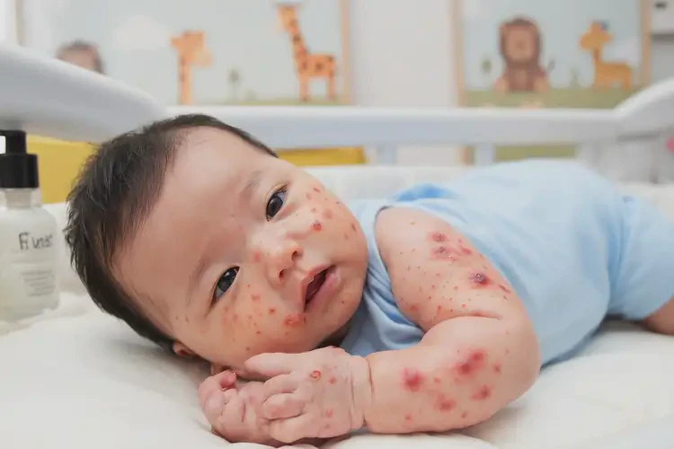 寶寶屁股起濕疹可以治好嗎(圖4)