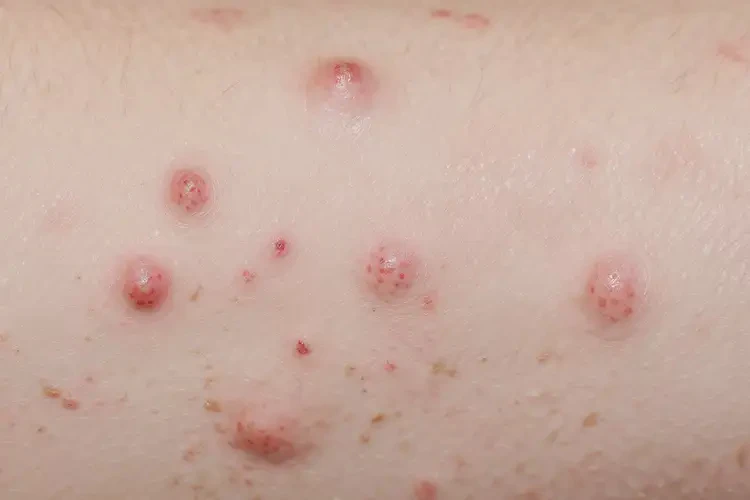 男生肛周出現(xiàn)濕疹可以治好嗎(圖4)