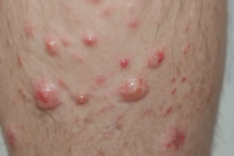 男性小腿上经常起湿疹可以治好吗(图3)