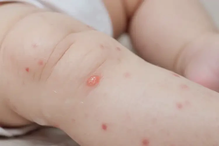 幼儿小腿容易长湿疹可以治好吗(图4)