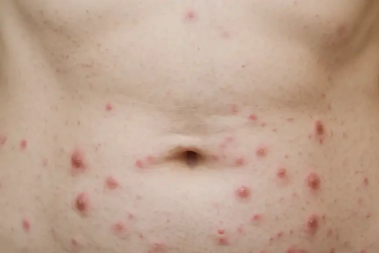 女性肚子上長濕疹可以治好嗎(圖4)