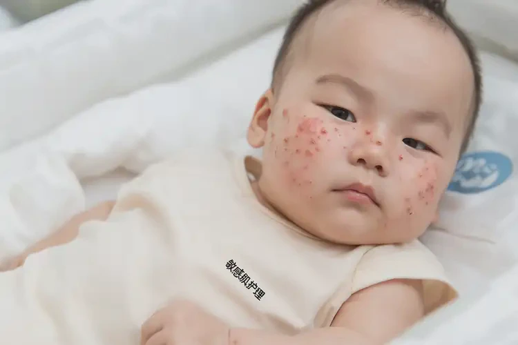 嬰幼兒屁股偶爾長濕疹不管它會自己好嗎(圖4)