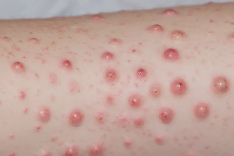 小兒肛周經(jīng)常長濕疹可以治好嗎(圖4)