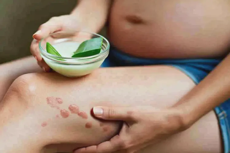 孕婦小腿上起濕疹可以治好嗎(圖1)