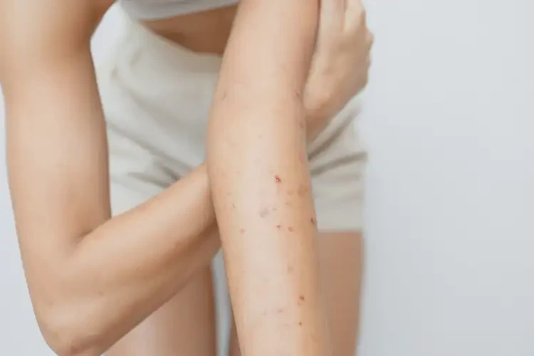 女性全身容易長濕疹可以治好嗎(圖4)