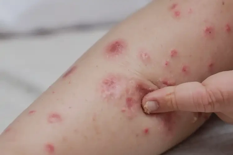 孩子小腿上起湿疹不管它会自己自愈吗(图4)