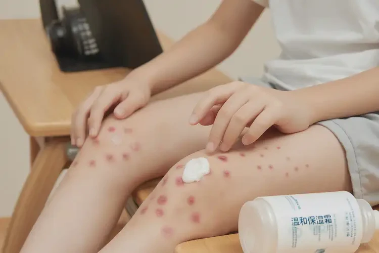 青少年小腿上經(jīng)常起濕疹可以治好嗎(圖3)