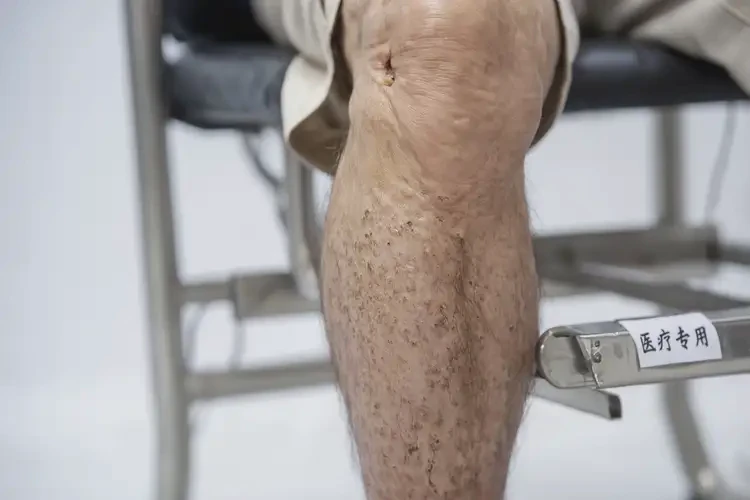 老年人小腿上偶爾長濕疹不管它會自己好嗎(圖2)